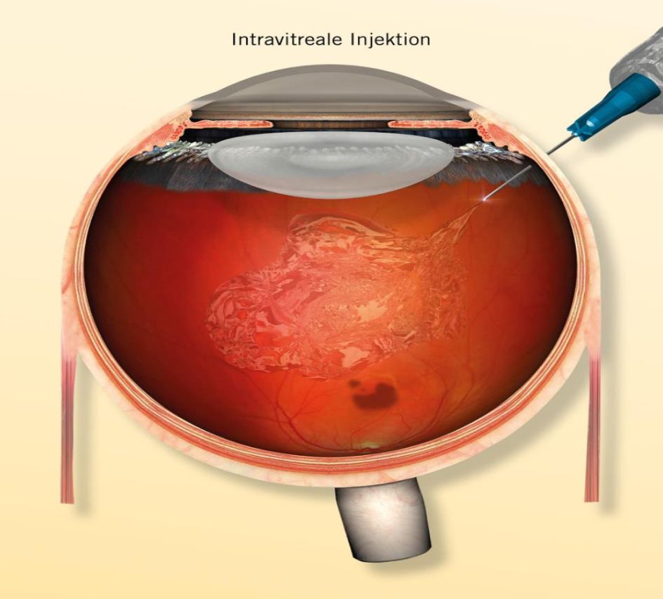 Intravitreale operative Medikamenteneingabe Intravitreale operative Medikamenteneingabe