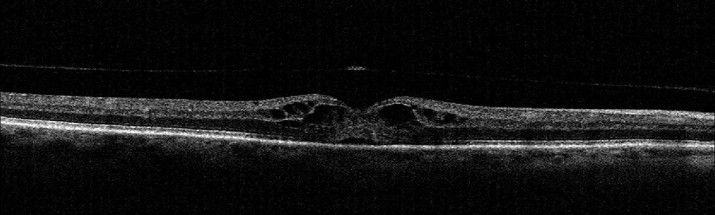 Intraretinale Flüssigkeit